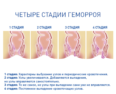 Лечение геморроя детралексом схема