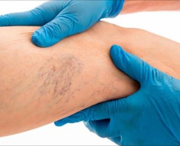 ретикулярный варикоз